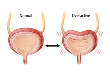 Here are Some Warning Signs of an Overactive Bladder