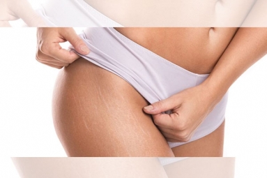 Difference between Red and White Stretch Marks Explained and It&rsquo;s Natural to Have Them