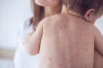 measles vaccination doses, measles in united states, measles back in the united states as children omit vaccination doses, Vaccination for children