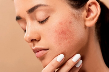 10 ways to get rid of Pimples at home